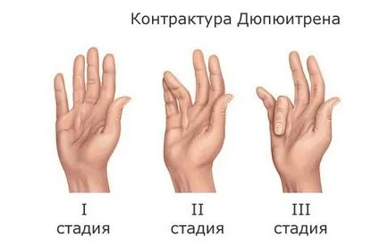 Дюпюитрен контрактура - за домашно лечение народни средства за защита (Дюпюитрен контрактура домашно лечение без операция след народни средства упражнения за рехабилитация) домашно лечение народни средства - контрактура Дюпюитрен