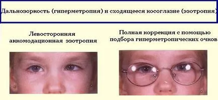 Кривогледство при възрастни медикаменти оправя у дома, води, отзиви