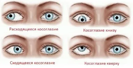 лечение кривогледство при възрастни - видове, причини и лечение