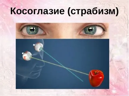 лечение кривогледство при възрастни - видове, причини и лечение