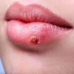 лечение на розацея у дома, снимки, мнения, причини, отстраняване
