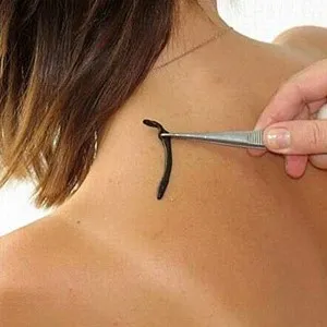 Лечението с пиявици у дома