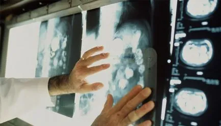 Лъчелечение Oncology видове процедури и ефектите на лечение (терапия) Лъчелечение Онкология видове процедури и ефекта от лечението