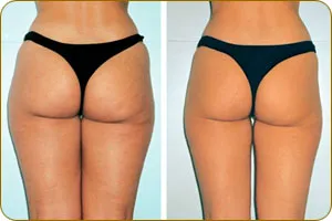 масаж LPG