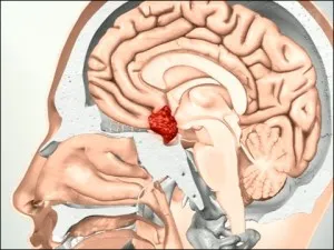 Microadenoma хипофизата симптоми и лечение за жените и мъжете