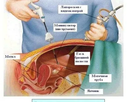 Миома на матката - признаци, симптоми, лечение