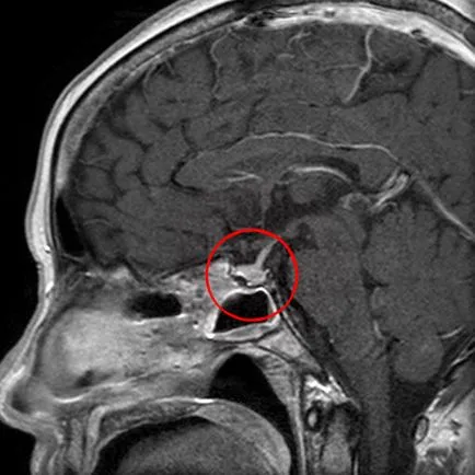 Microadenoma хипофизната причинява симптомите и лечения