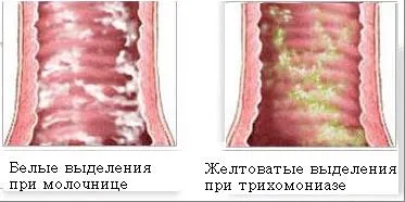 Млечница при жените, симптоми, лечение, снимки