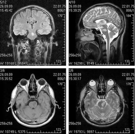 MRI в множествена склероза