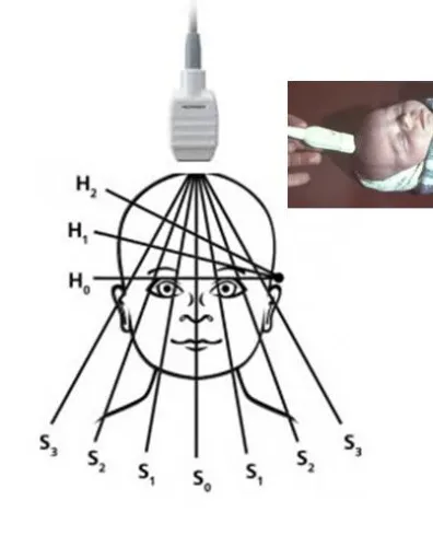 Neurosonography новородено четене, резултатите декодиращи