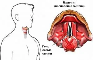 На ларинкса симптоми и лечение на детето и възрастни оток