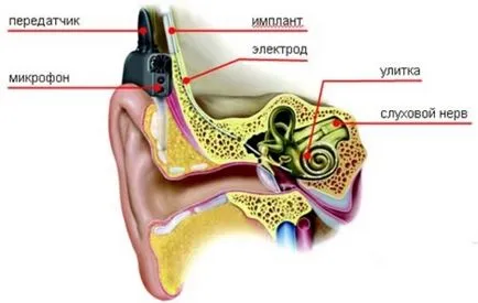 Отосклероза причини, симптоми, лечение и превенция (отосклероза хирургия мнения) Отосклероза причини, симптоми, лечение и превенция