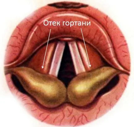 Подуване на гърлото - причини, признаци, симптоми и лечение (ларинкса) Подуване на гърлото - причини, признаци, симптоми и лечение