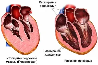 Сърдечни заболявания и вродени, придобити, причини и лечение