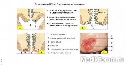 маточната шийка патология