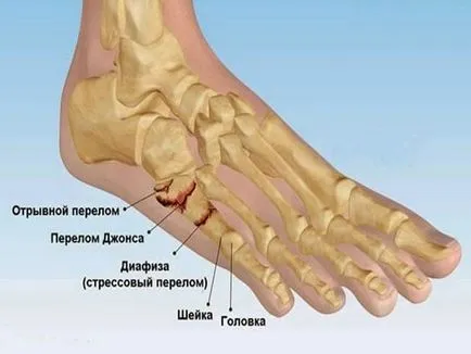 Фрактура на малкия пръст на крака си признаци, симптоми и лечение на народната медицина