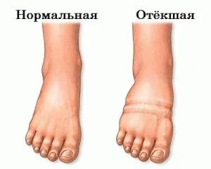 Защо през нощта подути крака, които трябва да бъдат предприети за борба с болестта (подуване) Защо през нощта подути крака, които трябва да бъдат предприети за борба с болестта