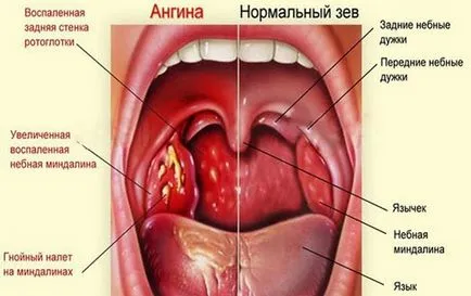 Защо боли корена на езика при преглъщане, причини и лечение (причини) Защо боли корена на езика при преглъщане, причини и лечение