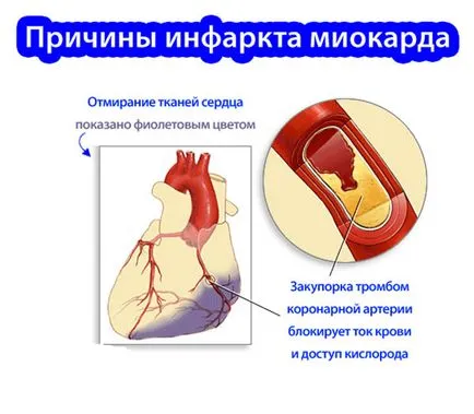 Причини за възникване на миокарден инфаркт - при мъжете, при жените, от това, което се случва, защо там,