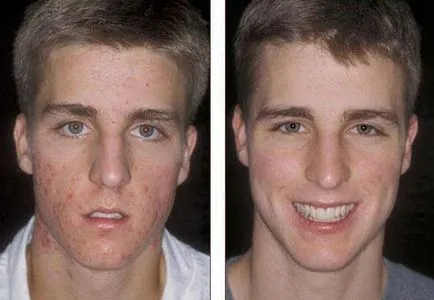 Roaccutane коментари, инструкции за употреба, цена, аналози, странични ефекти