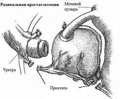 Независим извършване на масаж на простатата (да се направи масаж на простатата) Извършване на всякакви масаж на простатата