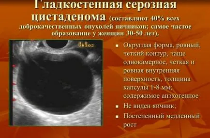 Серозна киста на яйчниците причини, симптоми, ефекти