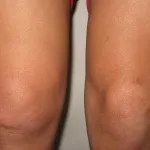 лечение синовит