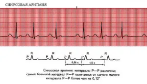 Синусова аритмия на ЕКГ