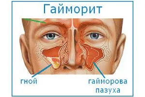Колко дни лечение синузит и как да се разбере това, което той отива
