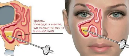 Колко дни лечение синузит и как да се разбере това, което той отива