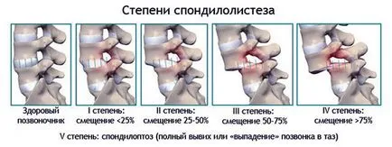 Преместването на шийните прешлени при възрастни, симптоми, лечение, последици