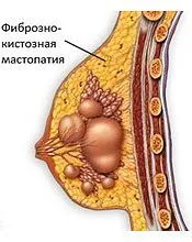 Diffúz cisztás mastopathia