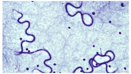 Dirofilariasis emberekben tünetei és kezelése