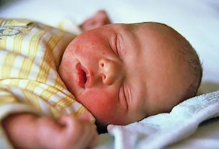 Hajlam gyermekeknél - a klinikai kép, a kezelés, a gyermekek, tots (hajlamosság) Hajlam gyermekeknél - a klinikai kép, a kezelés, gyermek, kisgyermek