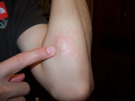 Dirofilariasis emberekben tünetei és kezelése