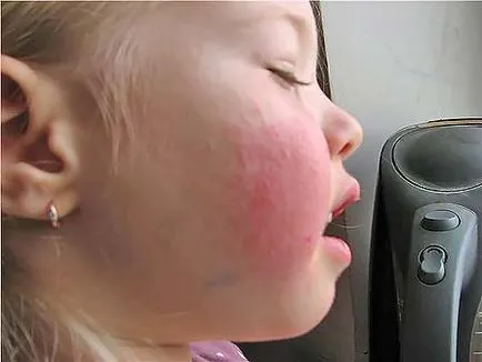Hajlam gyermekeknél - a klinikai kép, a kezelés, a gyermekek, tots (kezelés) Hajlam gyermekeknél - a klinikai kép, a kezelés, gyermek, kisgyermek