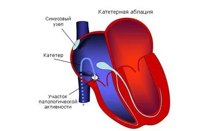 Тахиаритмии какво е, симптоми и лечение