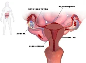 Хистеректомия ефекти от операцията