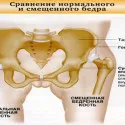 Uzi хип скорост на кърмачета ъгли и разстройства (стави) Узи хип размер на бебета ъгли и нарушения