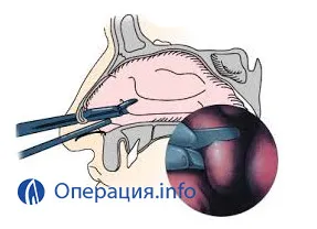 Vasotomy спирална кост, назално субмукозно резекция (субмукоза) Vasotomy спирална кост, назално субмукозно резекция