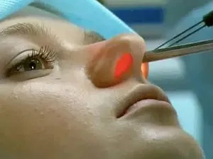 Vasotomy конхи какво е, причинява операция в долната част на носа и нейните видове