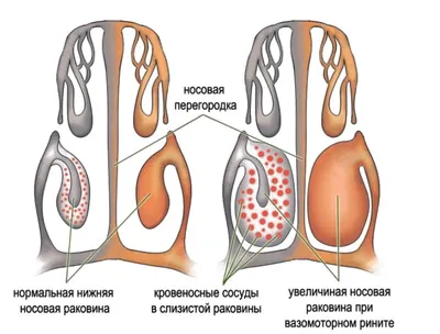 Vasotomy спирална, носната субмикозен резекция (черупки) Vasotomy спирална кост, назално субмукозно резекция