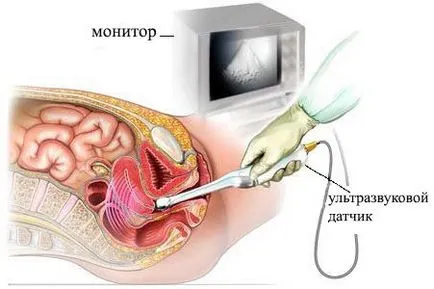 Таза ултразвук трансвагиналната, коремни, подготовка, цена