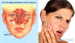 Максиларни киста в левия и десния максиларните синуси