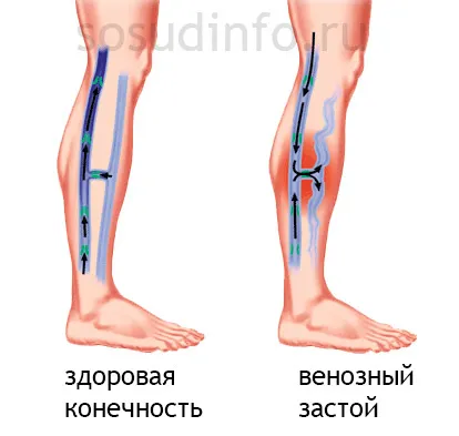 Венозна конгестия в главата, краката, таза и белите дробове