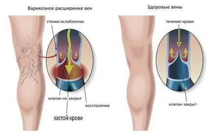 Венозна конгестия на мозъка кръвоносните съдове в главата, в таза при жените вена на крака, симптомите
