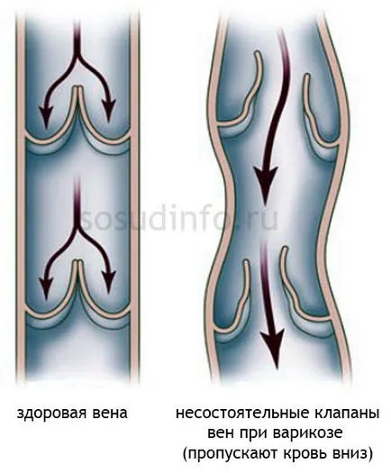 Венозна конгестия в главата, краката, таза и белите дробове