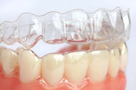 Всичко, което исках да знаете за aligners за подреждане на зъбите