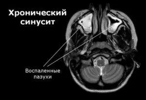 Хроничен синузит при възрастни симптоми, лечение, причини