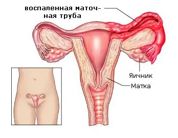 Хронична оофорит - лечение, симптоми, диагностика